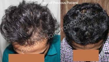 HAIR TRANSPLANT