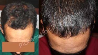 HAIR TRANSPLANT