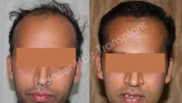 HAIR TRANSPLANT