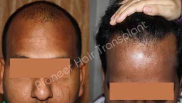 HAIR TRANSPLANT