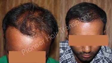 HAIR TRANSPLANT
