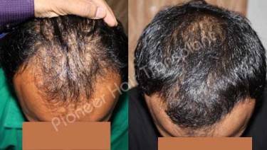 HAIR TRANSPLANT