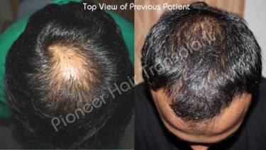 HAIR TRANSPLANT