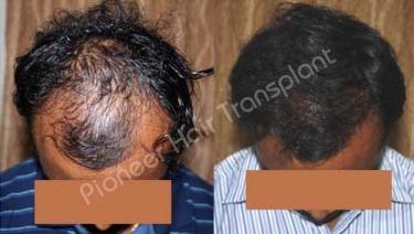 HAIR TRANSPLANT