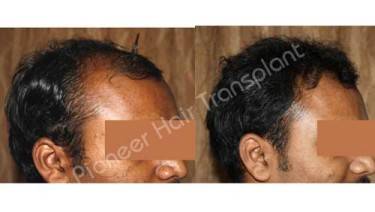 HAIR TRANSPLANT