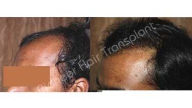 HAIR TRANSPLANT