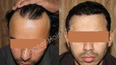 HAIR TRANSPLANT