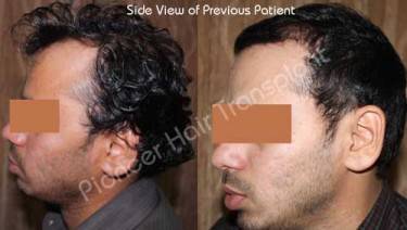 HAIR TRANSPLANT
