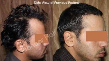 HAIR TRANSPLANT