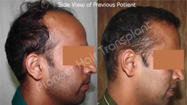 HAIR TRANSPLANT