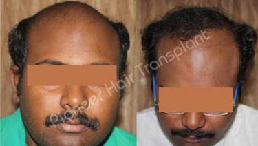 HAIR TRANSPLANT