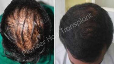 HAIR TRANSPLANT