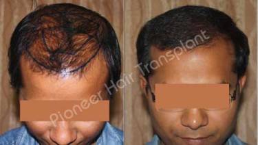 HAIR TRANSPLANT