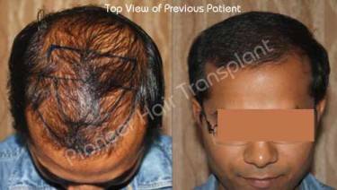 HAIR TRANSPLANT
