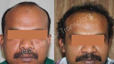 HAIR TRANSPLANT