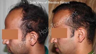 HAIR TRANSPLANT