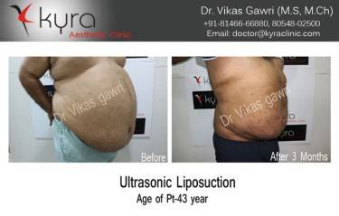 LIPOSUCTION MALE