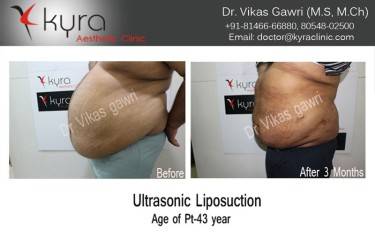LIPOSUCTION MALE