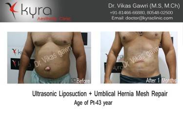 LIPOSUCTION MALE