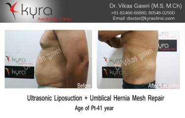 LIPOSUCTION MALE