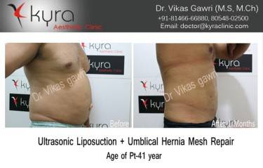 LIPOSUCTION MALE