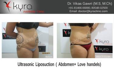 LIPOSUCTION FEMALE