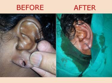 Ear Repair / Earlobe Piercing