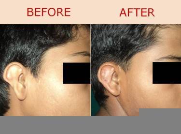 Ear Repair / Earlobe Piercing