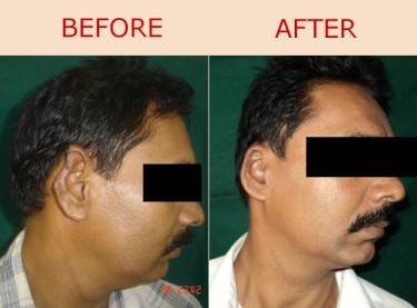 Ear Repair / Earlobe Piercing