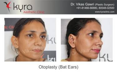 OTOPLASTY