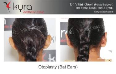 OTOPLASTY