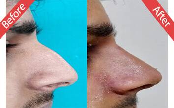 Rhinoplasty