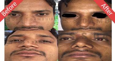 Rhinoplasty