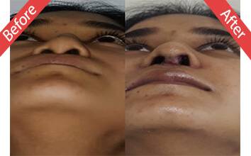 Rhinoplasty