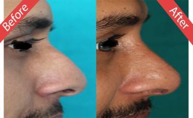 Rhinoplasty