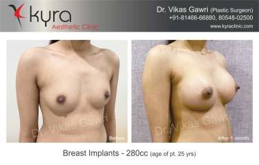 BREAST IMPLANTS