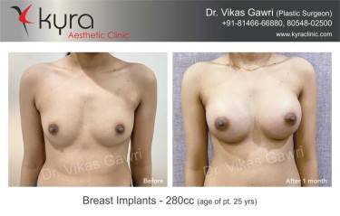 BREAST IMPLANTS