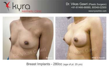 BREAST IMPLANTS