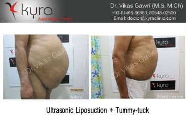 ABDOMINOPLASTY