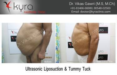 ABDOMINOPLASTY