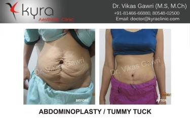 ABDOMINOPLASTY