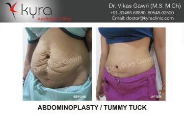 ABDOMINOPLASTY
