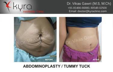 ABDOMINOPLASTY