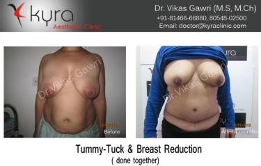 BREAST REDUCTION