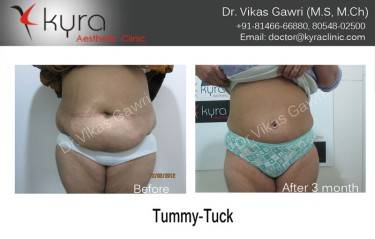 ABDOMINOPLASTY
