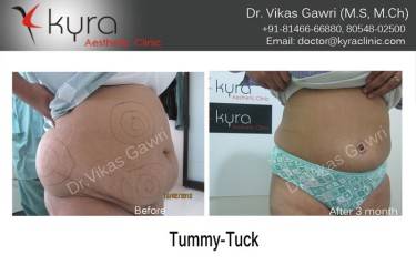 ABDOMINOPLASTY