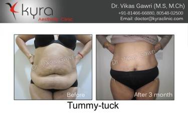 ABDOMINOPLASTY