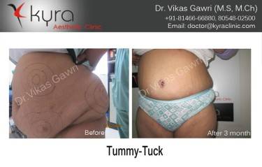 ABDOMINOPLASTY