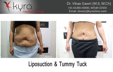 ABDOMINOPLASTY