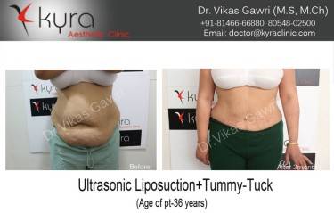 ABDOMINOPLASTY